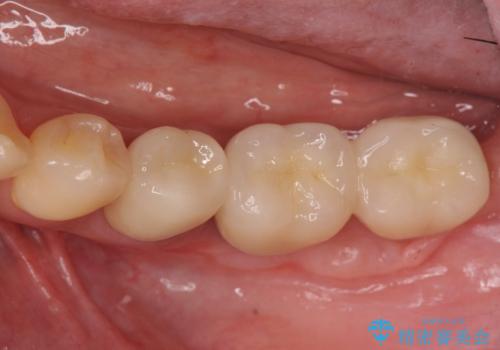 歯ブラシのしやすい環境を整えるインプラント治療の治療後