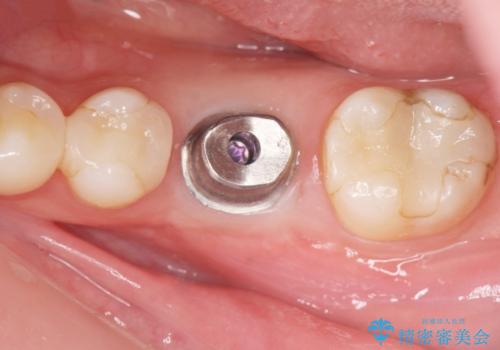 欠損部のインプラント補綴の治療中