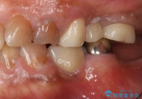 奥歯のスペースを埋めたい フルジルコニアブリッジの治療後