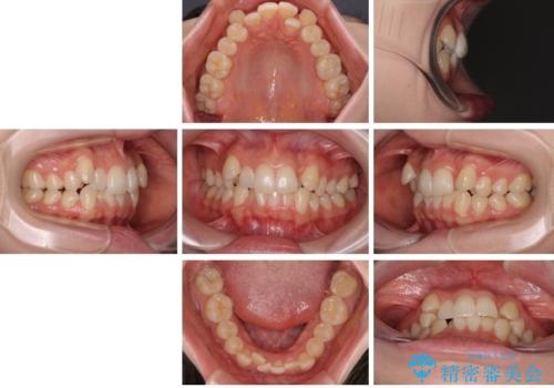 八重歯が気になる。補助装置を併用したワイヤー矯正の治療前