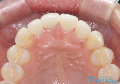 金属色の見える前歯 オールセラミックで審美治療の治療後