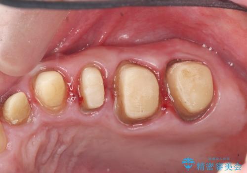 虫歯だらけの歯を治療したいの治療中
