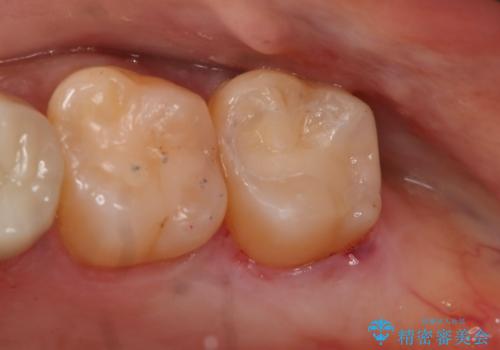 銀歯のやり変え希望 セラミックインレー