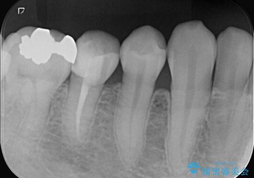 虫歯治療|歯を長持ちさせるための治療|セラミッククラウン|審美回復|精密根管治療の治療中