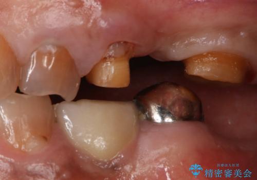 奥歯のスペースを埋めたい フルジルコニアブリッジの治療中