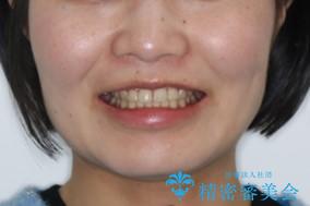 部分矯正で前歯をなおしたい→全顎ワイヤー矯正できちんと治すの治療後(顔貌)