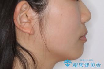 下顎前歯の先天欠損と上顎前歯のクロスバイト:インビザライン治療の治療前(顔貌)