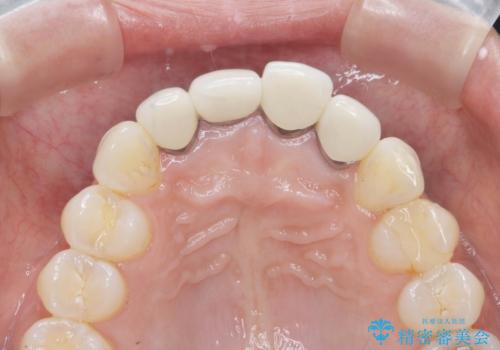 金属色の見える前歯 オールセラミックで審美治療の治療前