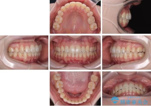 八重歯が気になる。補助装置を併用したワイヤー矯正の治療後