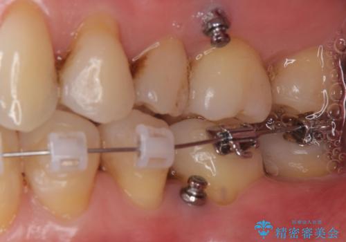 奥歯が倒れてしまっている 親知らずを利用した矯正の治療中