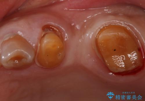 奥歯のスペースを埋めたい フルジルコニアブリッジの治療中