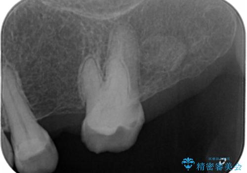 奥歯のスペースを埋めたい フルジルコニアブリッジの治療前