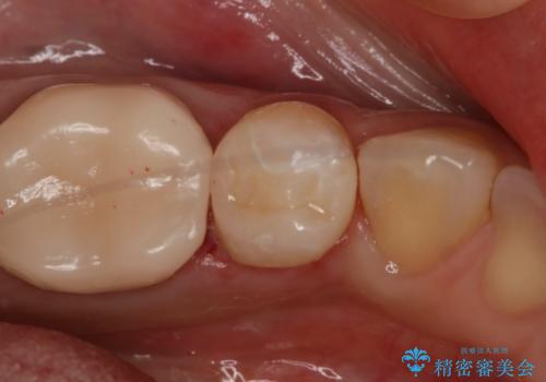 銀歯を白くしたい セラミックインレー