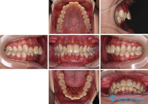 深い咬み合わせと前歯のデコボコ ワイヤー装置での抜歯矯正の治療前