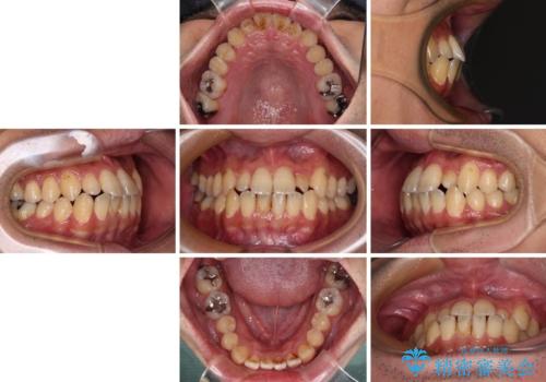 内側に引っ込んだ歯を治したい インビザラインの矯正治療の治療前
