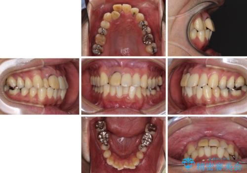 隠れている前歯 インビザライン矯正治療と前歯のセラミック治療の治療前