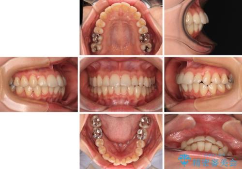 上下前歯のデコボコ ワイヤー装置で楽ちん矯正治療の治療前