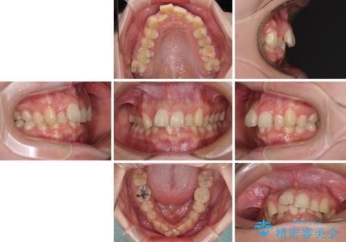 【モニター】デコボコ前歯を治したい ワイヤー装置での抜歯矯正治療の治療前