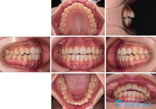 上下非接触の前歯 口元の突出感を改善する抜歯矯正の治療前