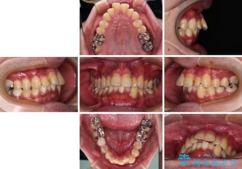 【モニター】飛び出した上の前歯 非抜歯矯正で整った口元にの治療前