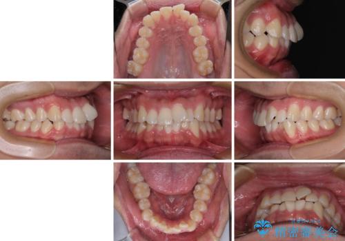 前方に捻れた前歯を治したい インビザライン矯正治療の治療前