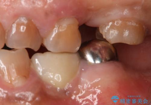 奥歯のスペースを埋めたい フルジルコニアブリッジの治療前