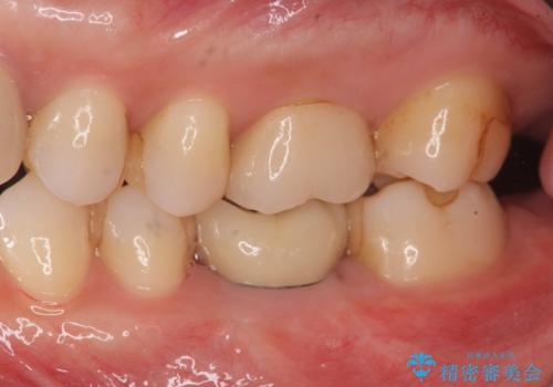 欠損部のインプラント補綴の治療後