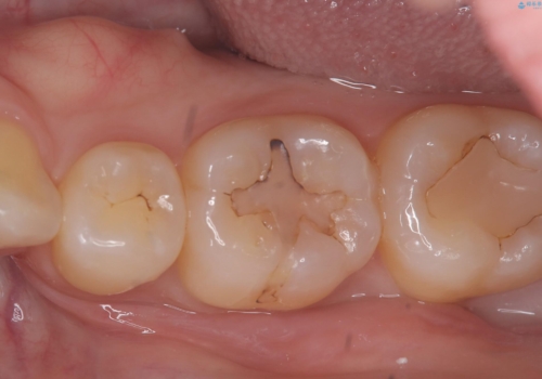 【セラミックインレー】プラスチックの劣化が気になる