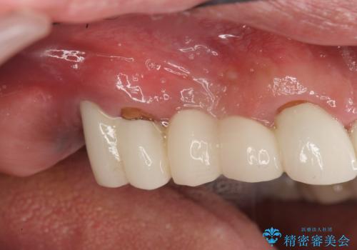 歯がずっと疼く 根本的な治療の希望の症例 治療前