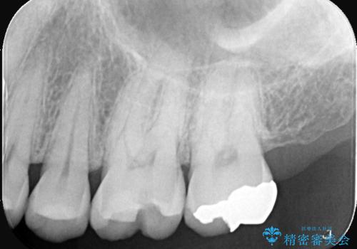 【セラミックインレー】銀の詰め物が外れてしまったの治療前