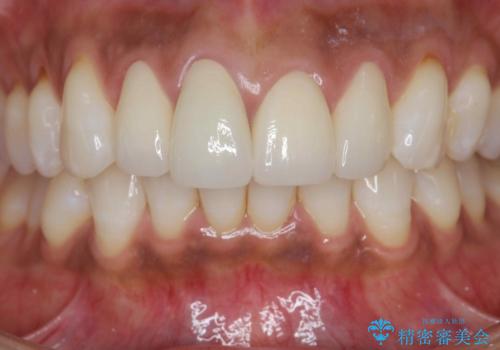 金属色の見える前歯 オールセラミックで審美治療の治療後