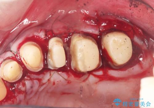 虫歯だらけの歯を治療したいの治療中