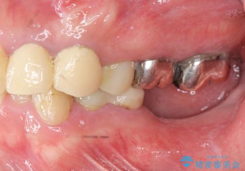虫歯だらけの歯を治療したいの治療前