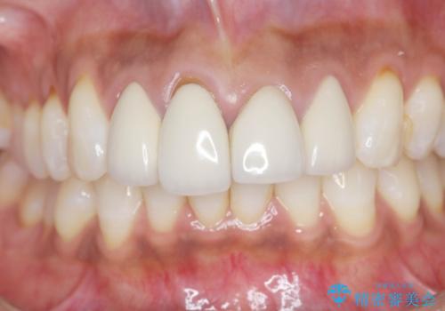 金属色の見える前歯 オールセラミックで審美治療の治療前