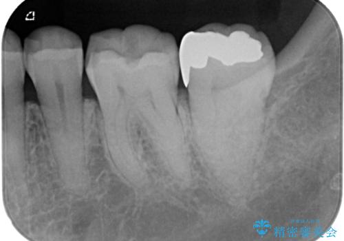銀歯がとれたのでついでに他もやり替えたい セラミックインレー修復・セラミックアンレー修復の治療前