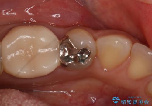 銀歯を白くしたい セラミックインレーの治療前