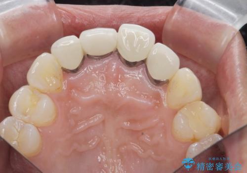 金属色の見える前歯 オールセラミックで審美治療の治療前