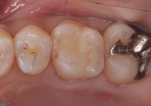 【セラミックインレー】銀の詰め物が外れてしまったの治療後
