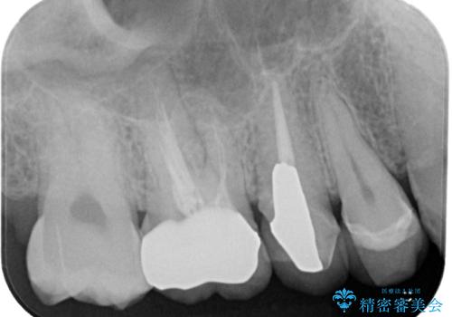 セラミックが欠けた オールセラミッククラウンの治療後