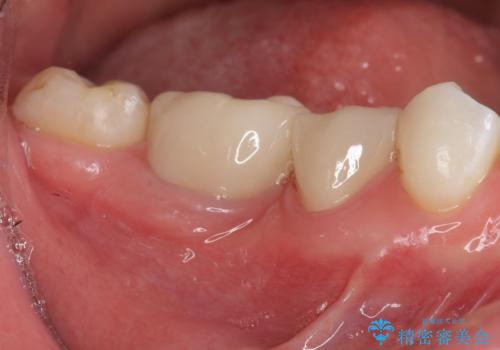 銀歯を白くしたい セラミック治療の症例 治療後