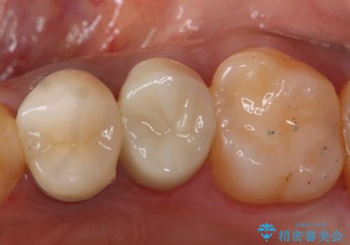 う蝕除去中に露髄 フルジルコニアクラウンの治療後
