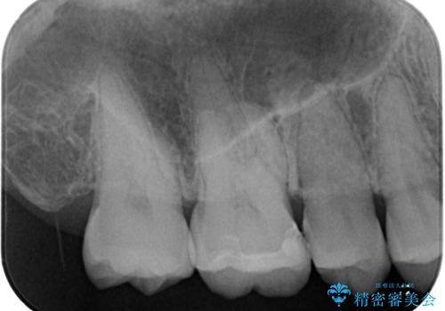 上の銀歯をやり替えたい セラミックインレー修復の治療後