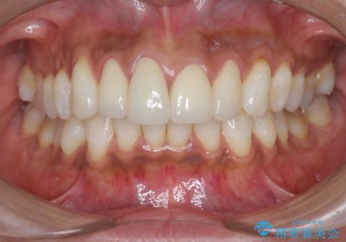 金属色の見える前歯 オールセラミックで審美治療の治療後