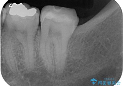 詰め物が欠けて虫歯になってる気がする セラミックインレー修復の治療後