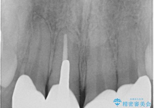 金属色の見える前歯 オールセラミックで審美治療の治療前