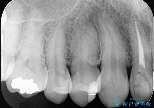 虫歯治療|歯を長持ちさせるための治療|セラッミクインレー|審美回復の治療後