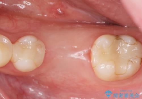 欠損部のインプラント補綴の治療前