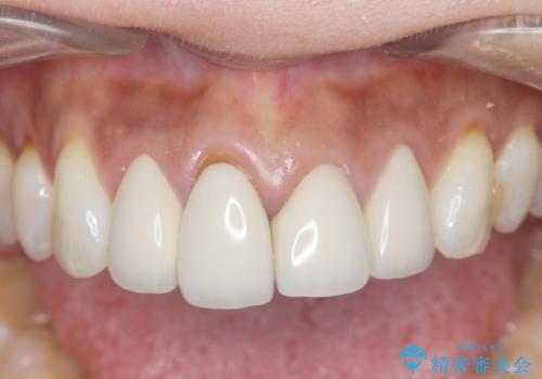 金属色の見える前歯 オールセラミックで審美治療の治療前