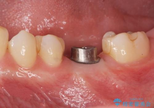 欠損部のインプラント補綴の治療中