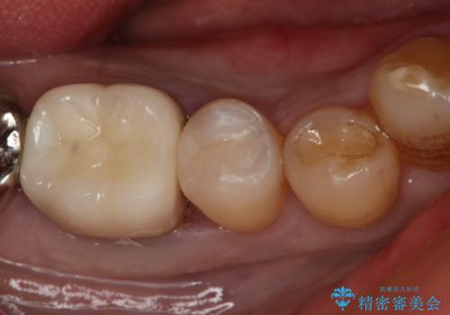 保険材料をセラミックにやり変えたい セラミックインレー